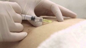Terapias alternativas en SED. Proloterapia