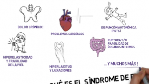 Vídeo educativo sobre el Síndrome de Ehlers-Danlos